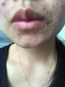 中华医药治疗痤疮视频,痤疮治疗新视角